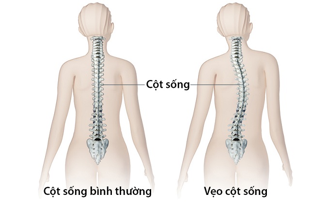 Vẹo cột sống là tình trạng đốt sống bị lệch sang một bên