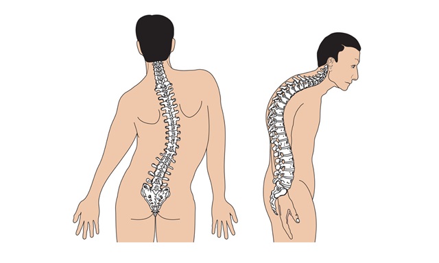 Cong vẹo cột sống là bệnh gì?