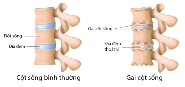 gai cột sống cổ, trị liệu đông y