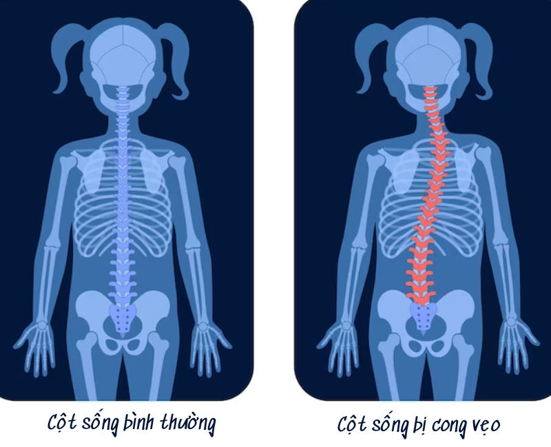 Cảnh Báo Về Vấn Đề Cột Sống Cong Vẹo