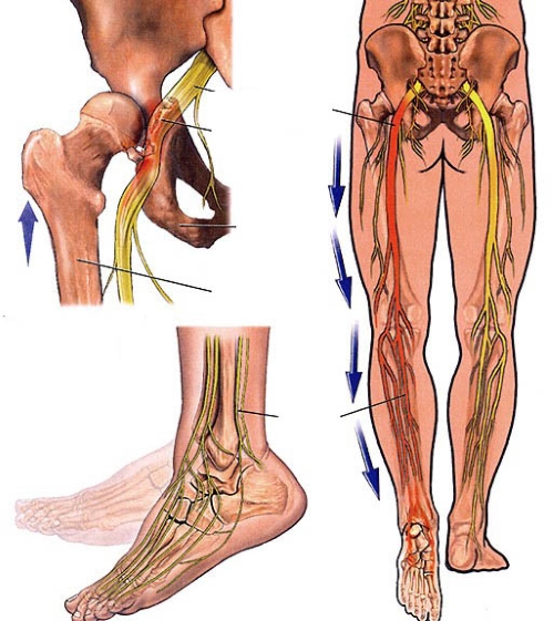 Cách Giảm Ngay Cơn Đau Thần Kinh Tọa Tại Nhà