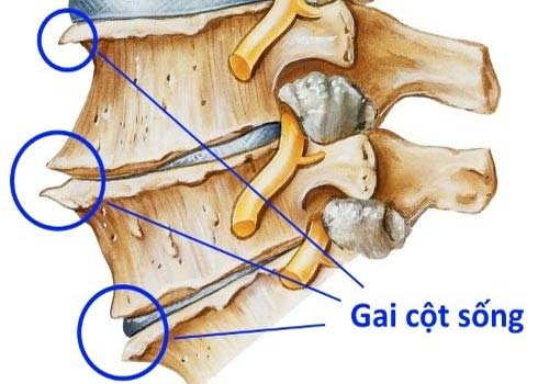  Hiểu Rõ Các Dấu Hiệu Và Vị Trí Của Gai Cột Sống