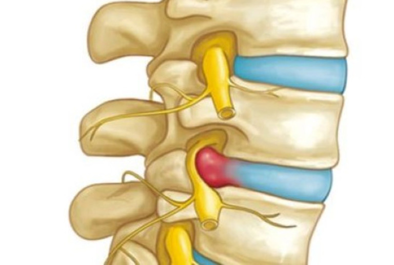 Gai Đôi Cột Sống S1