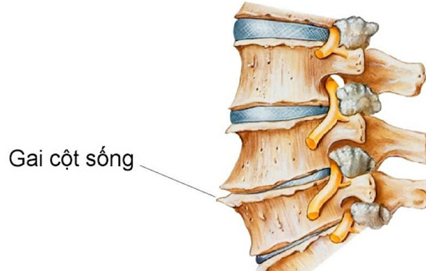 Hiểu Rõ Các Dấu Hiệu Và Vị Trí Của Gai Cột Sống