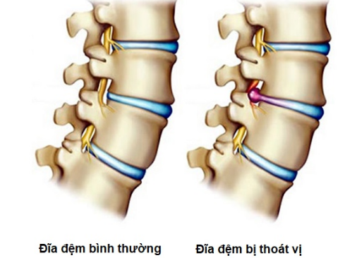 5 cách chữa thoát vị đĩa đệm bằng đu đủ