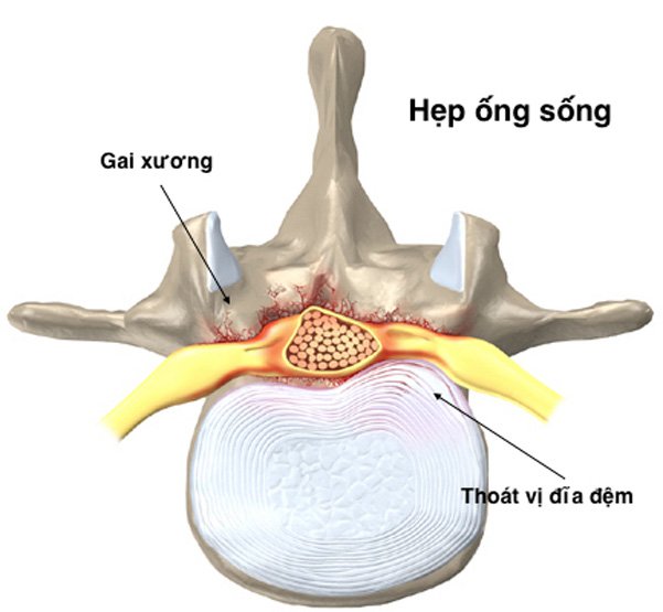 Mối nguy từ các cơn đau thắt lưng